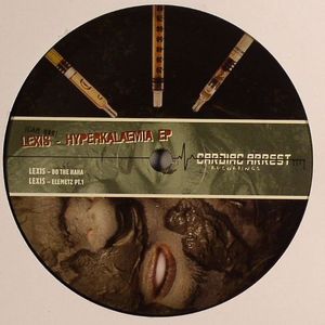 Hyperkalaemia EP